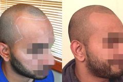 Scalp Coverage & New Hairline - First session