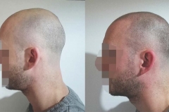 Scalp Coverage & New Hairline - First session