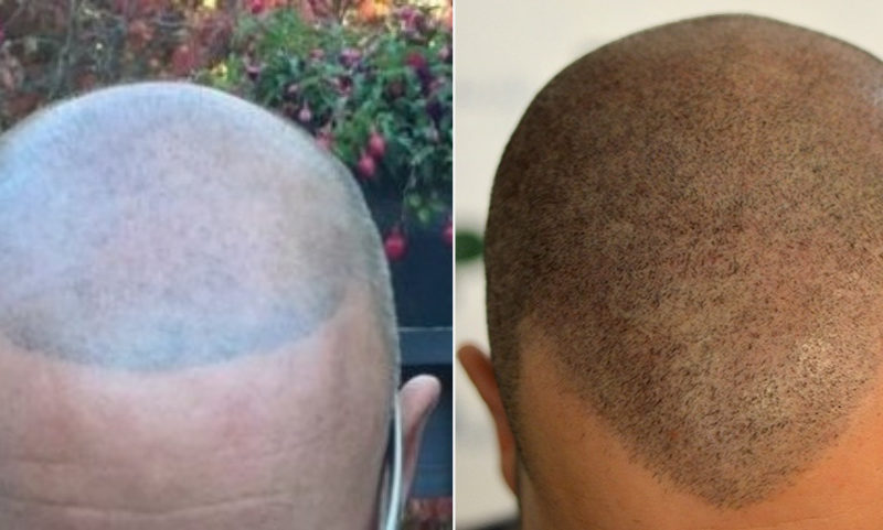 A Guide to Hairline Tattoos with Scalp Micropigmentation (SMP)